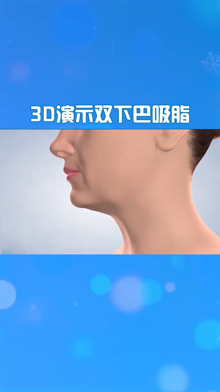 双下巴吸脂的全过程是怎样的3d动画带你了解