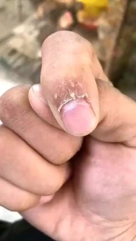 搞笑段子处理手指倒刺的最佳选择小伙的操作真够牛的