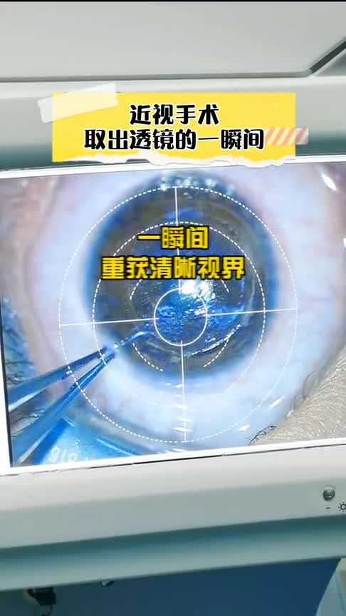 激光在角膜上扫描出一片透镜,取出来,视界从此就清晰了!