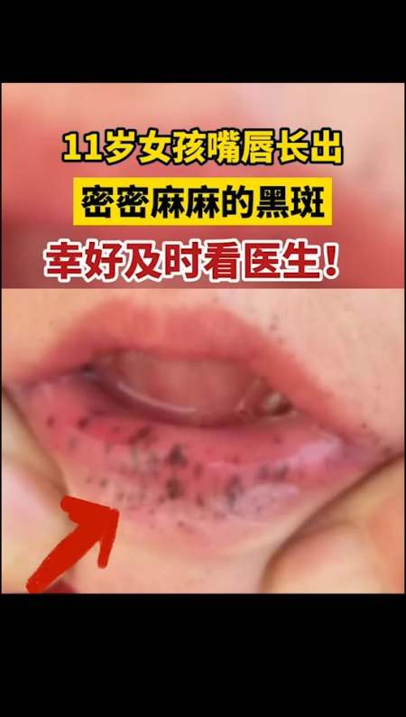 我要上热门#11岁女孩 嘴唇长出密密麻麻的黑斑,幸好及时看医生!