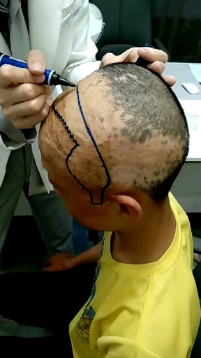 种发第二天,看着害怕,其实一点都不疼的.从此告别单身和自卑!