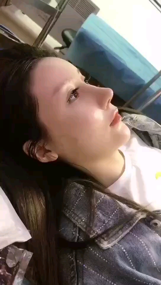 小姐姐#肋骨鼻术后七天,恢复的还可以吧