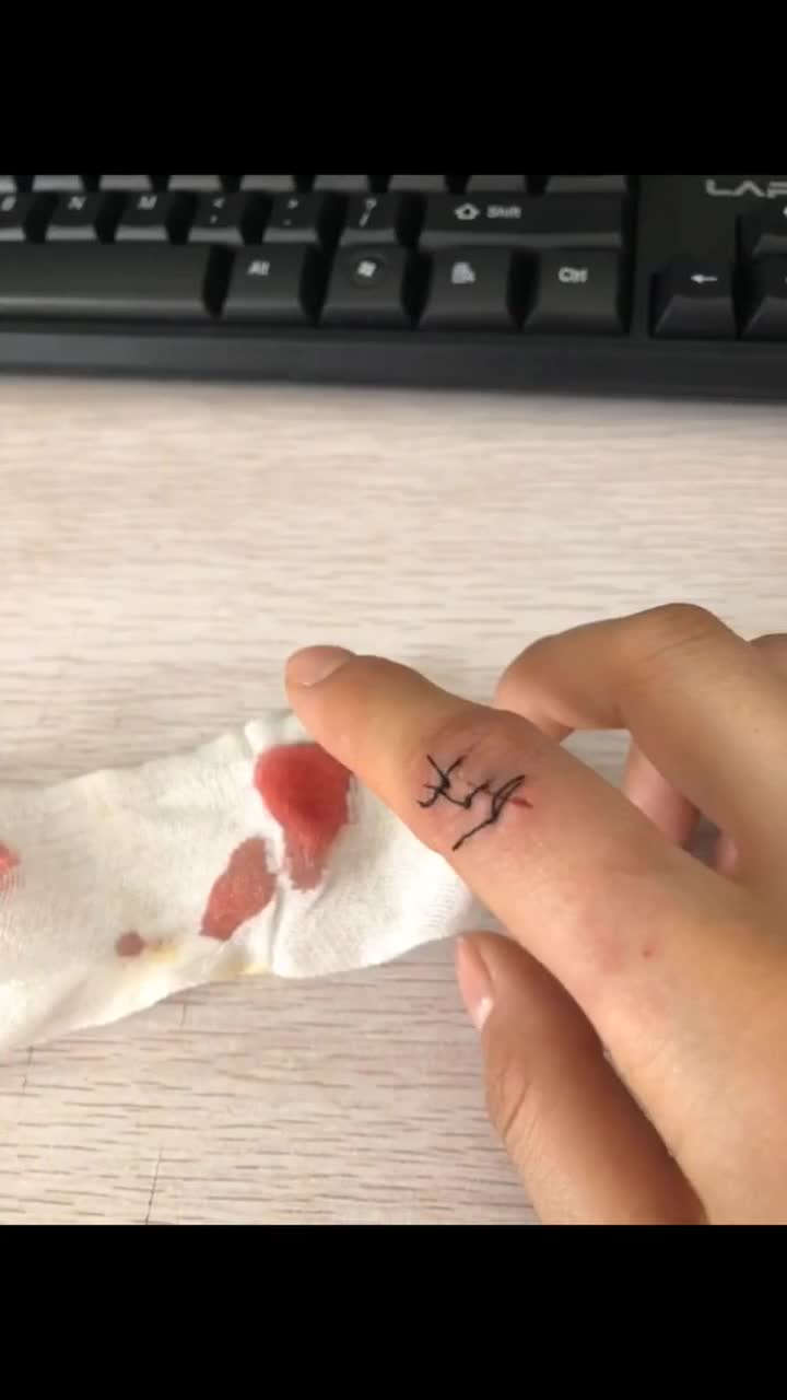 铅笔芯扎肉里二十多年了,今天终于弄出来了