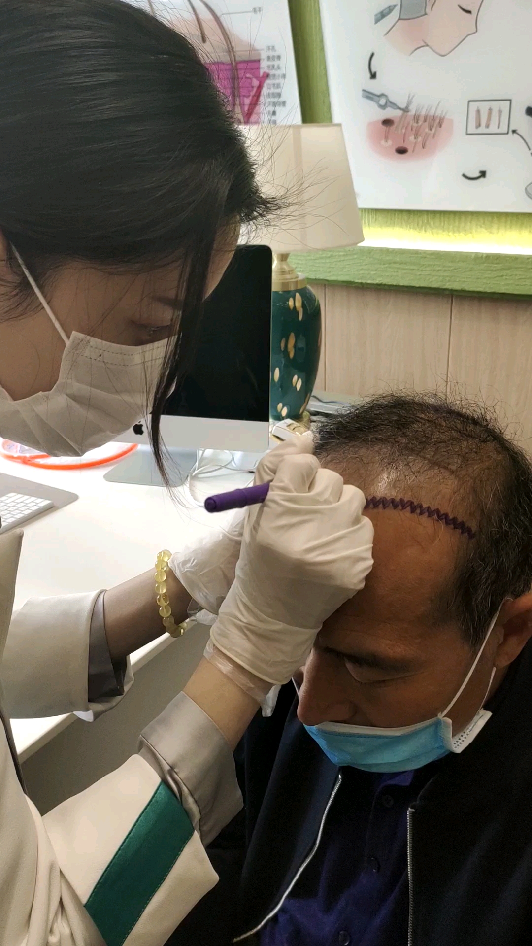 种发第二天,看着害怕,其实一点都不疼的,告别自卑的自己,重拾自信!