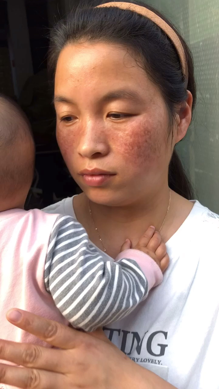 忘不掉那段满脸黑麻子的经历,希望抛弃我的那个你能够看到这个视频