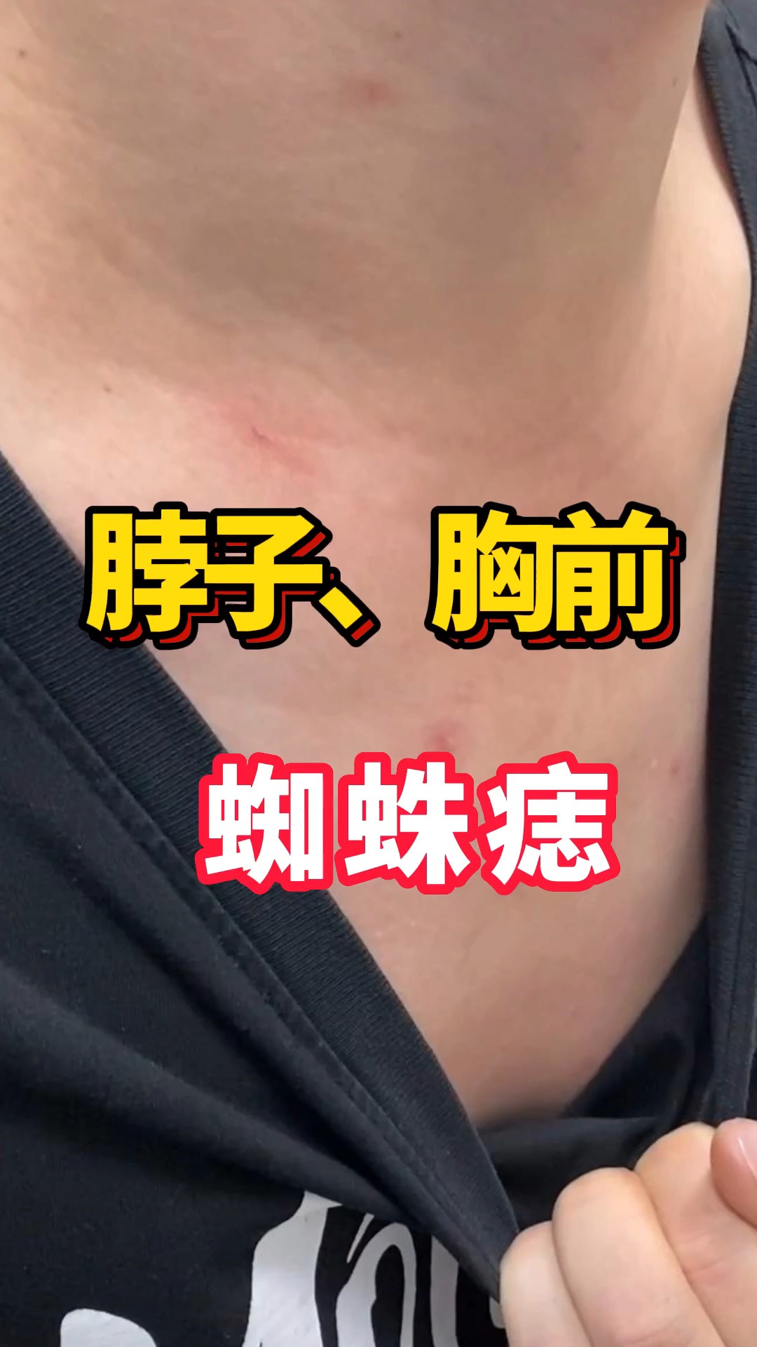 肝病#小红点是蜘蛛痣吗?