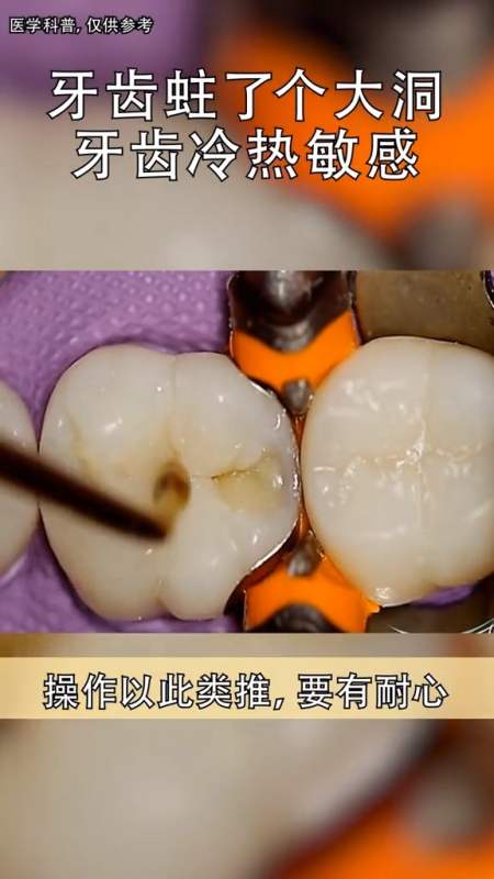 我要上热门#牙齿蛀了个大洞,不要慌还能救!