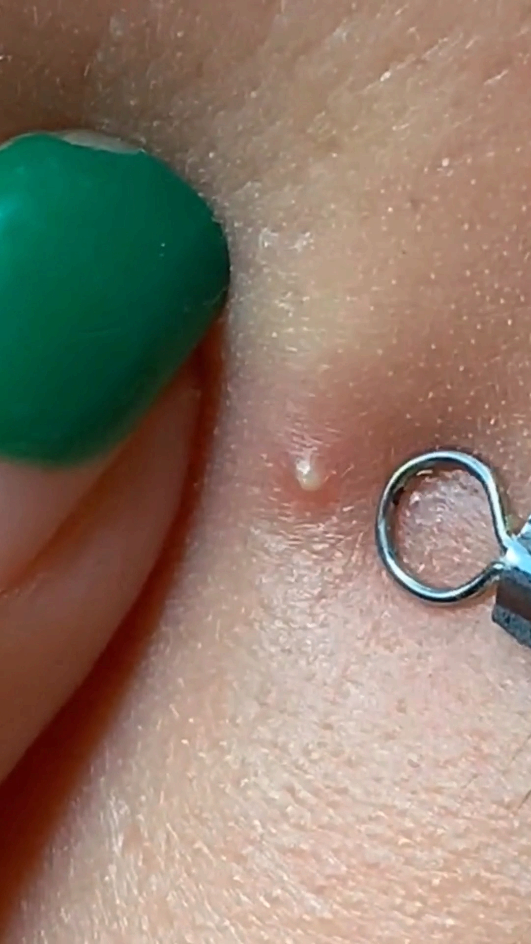 痘痘挤出来的脓水危害到底有多大-度小视