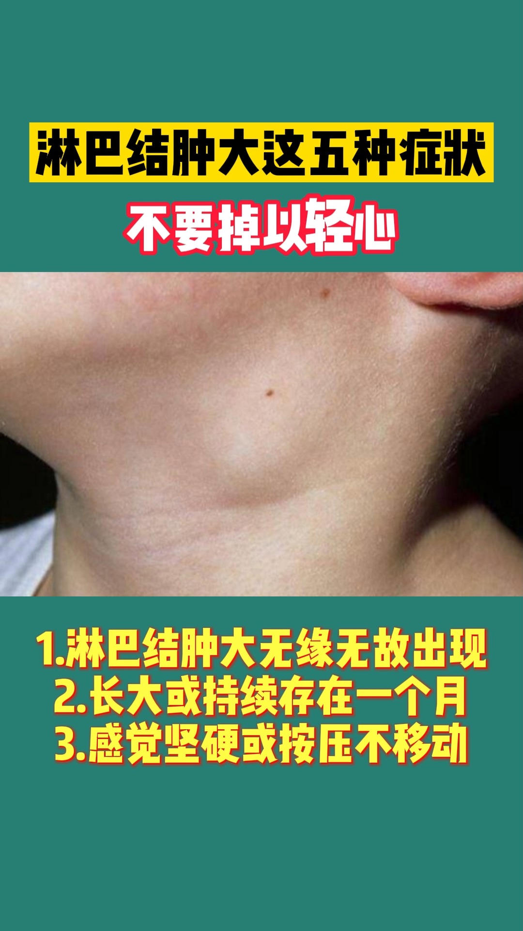 健康养生#淋巴结肿大这五种情况要警惕
