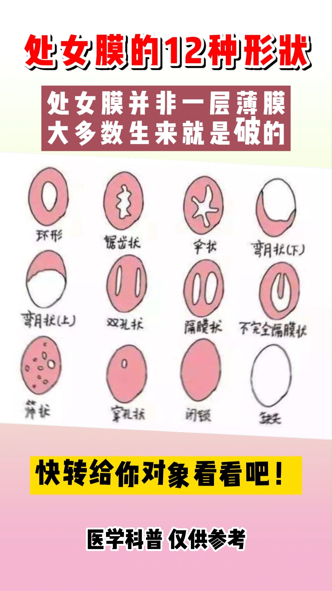 关爱女性健康#妇科#处女膜的12种形状