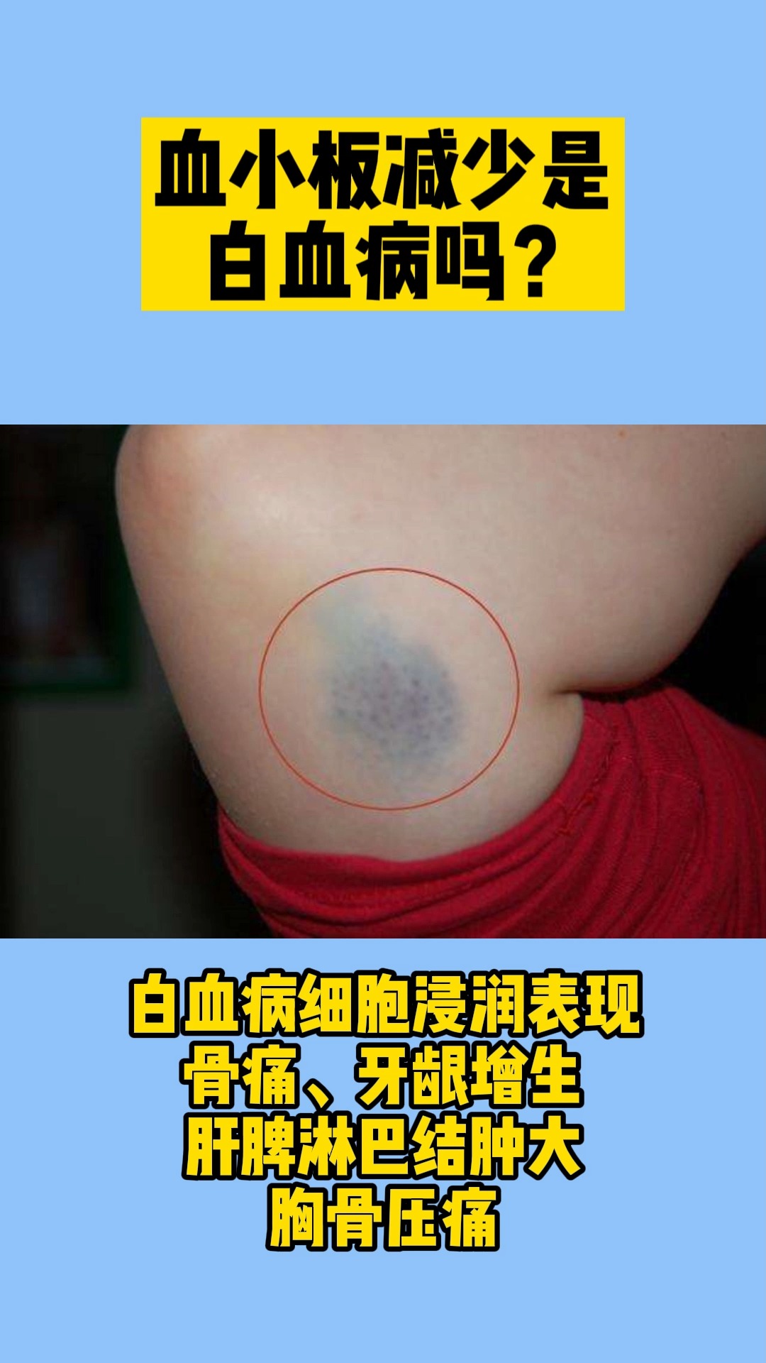 白血病血小板减少是白血病吗