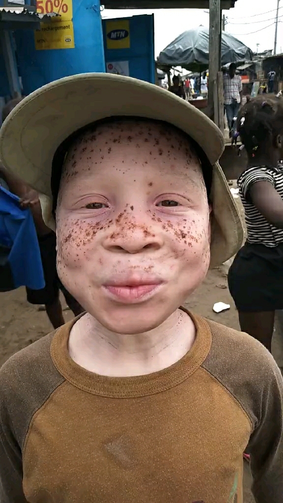 黑人娃娃得白癜风现在几乎全白了,不知道在非洲能把他当异类不!