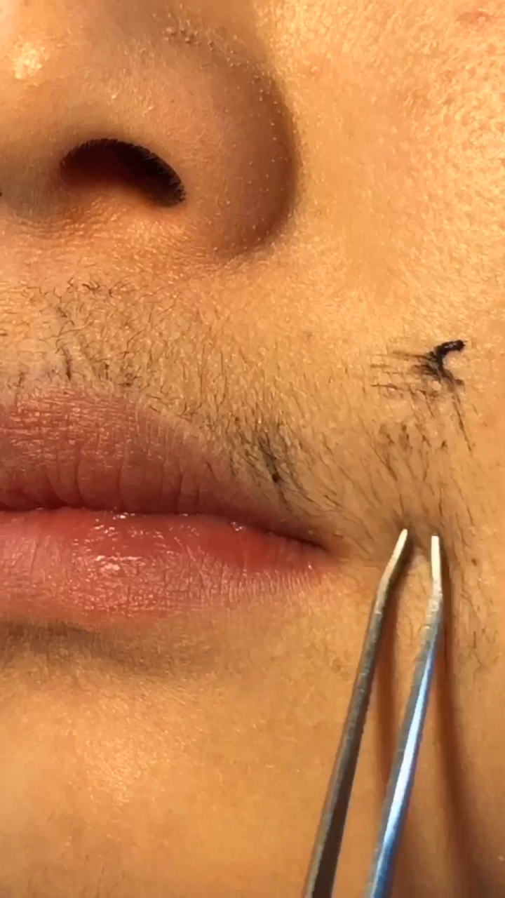 我要上热门#嘴角周围张了小胡子怎么办?看过来一招教你解决