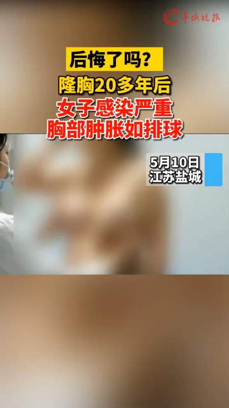 隆胸20多年后,女子感染严重胸部肿胀如排球