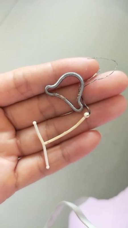 这是我带了十三四年的两个环,女人除了生孩子痛,还有一种痛,叫取环痛