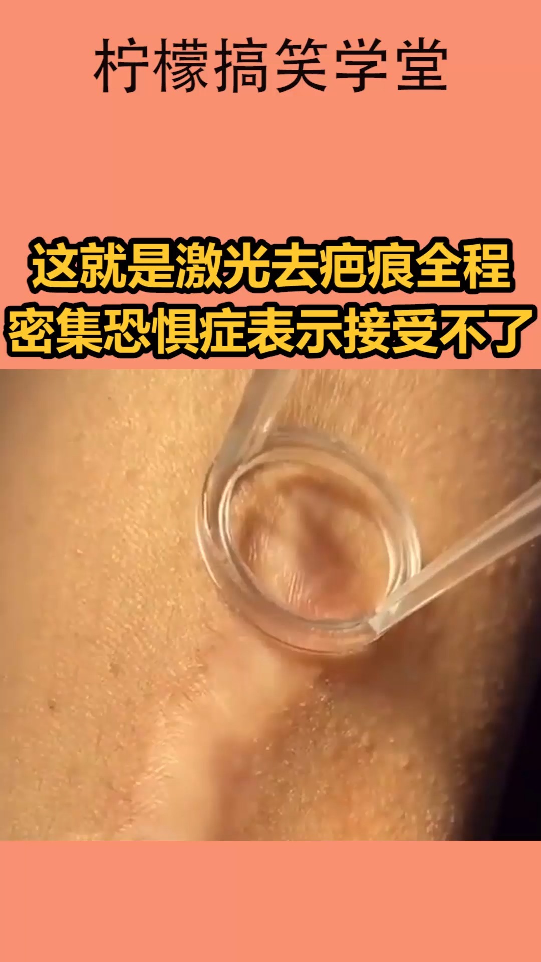 我要上热门这就是激光去疤痕全程密集恐惧症表示接受不了