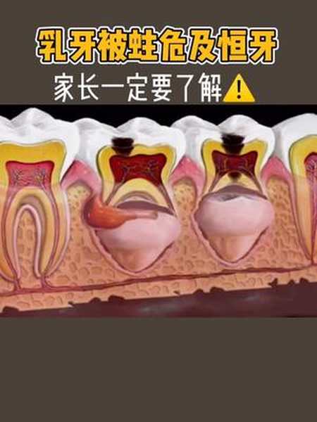 看如果孩子乳牙被蛀要及时去补不然会影响恒牙的生长口腔科普乳牙蛀牙