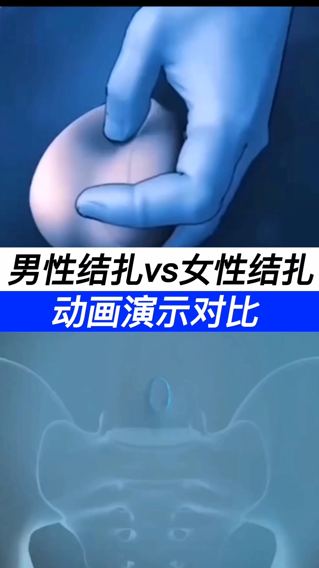 医学科普男性结扎vs女性结扎动画演示对比