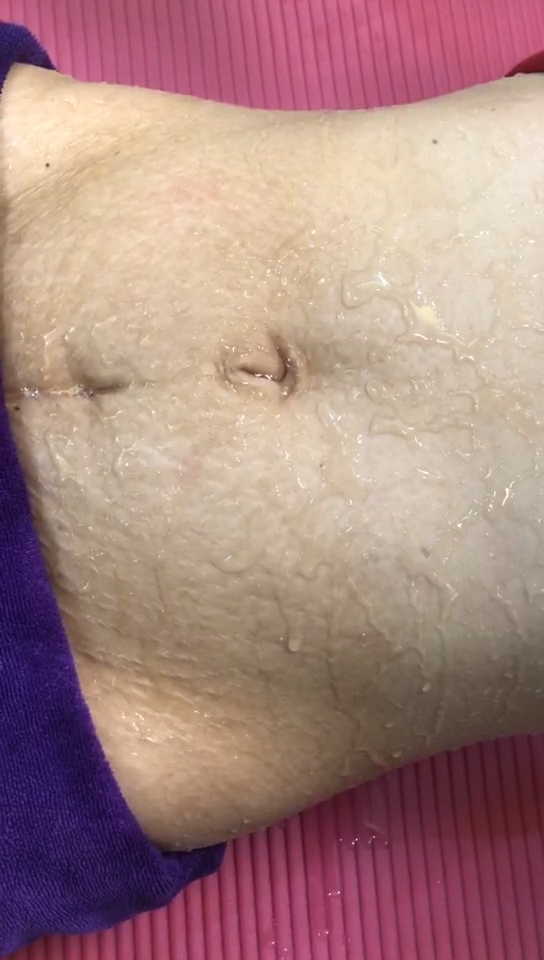 不节食不运动,轻松暴瘦40斤.淡化妊娠纹