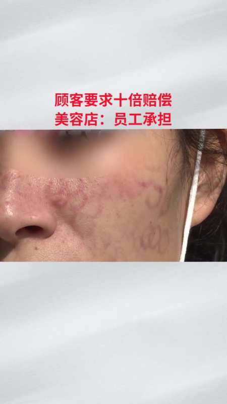 脸上被"拔罐",美容变"毁容"(二)