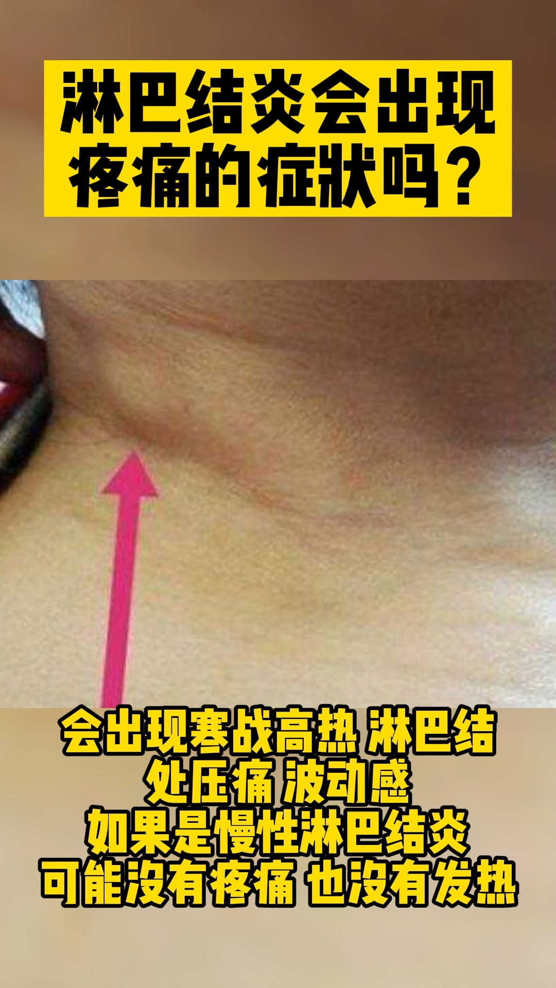 去淋巴淋巴结炎会出现疼痛的症状吗