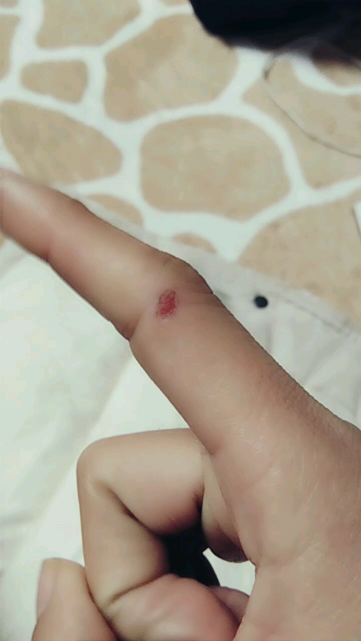 天天不敢弯手指,一弯就裂开,这还真是个特别的新年礼物,哎