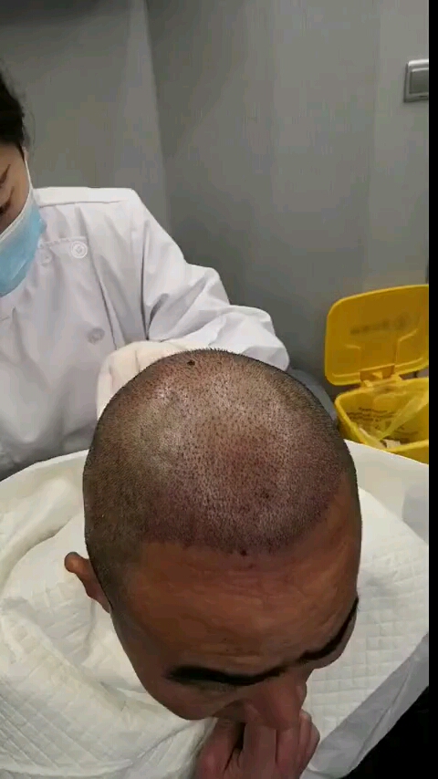 刚刚种完头发,才第七天的时间头顶的小发茬就长出来了,根根清晰可见