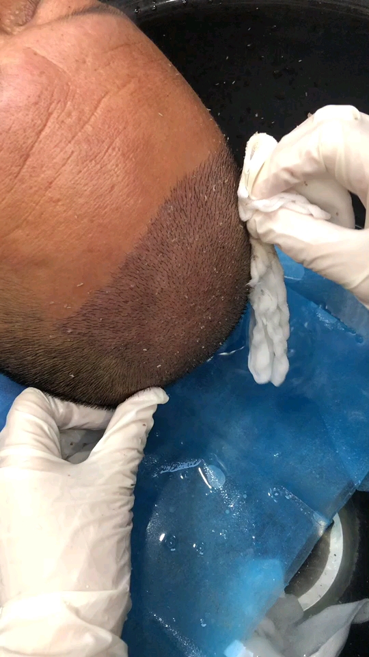 种发第二天,看着害怕,其实不疼的.从此告别单身和自卑!