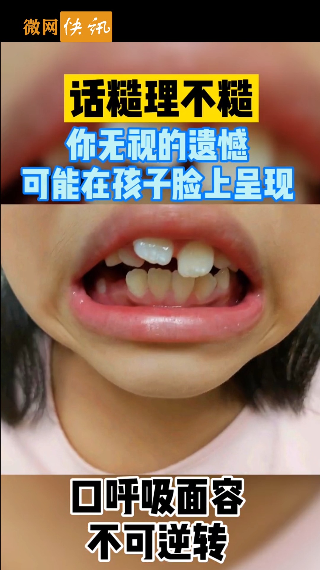 全民正能量#孩子口呼吸面容不可逆转,家长的无视都表现在孩子脸上