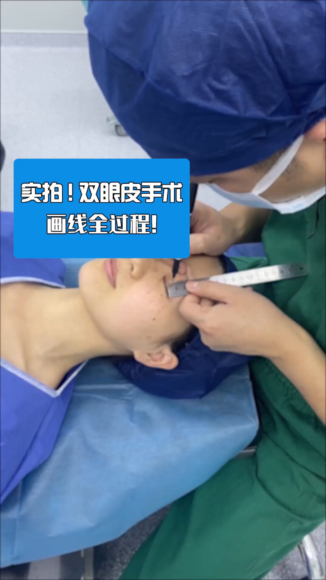 全民医生说#实拍双眼皮手术画线的全过程