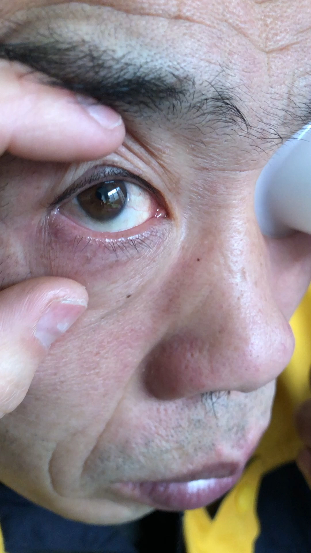 高龄老人眼内的垃圾多的吓到你