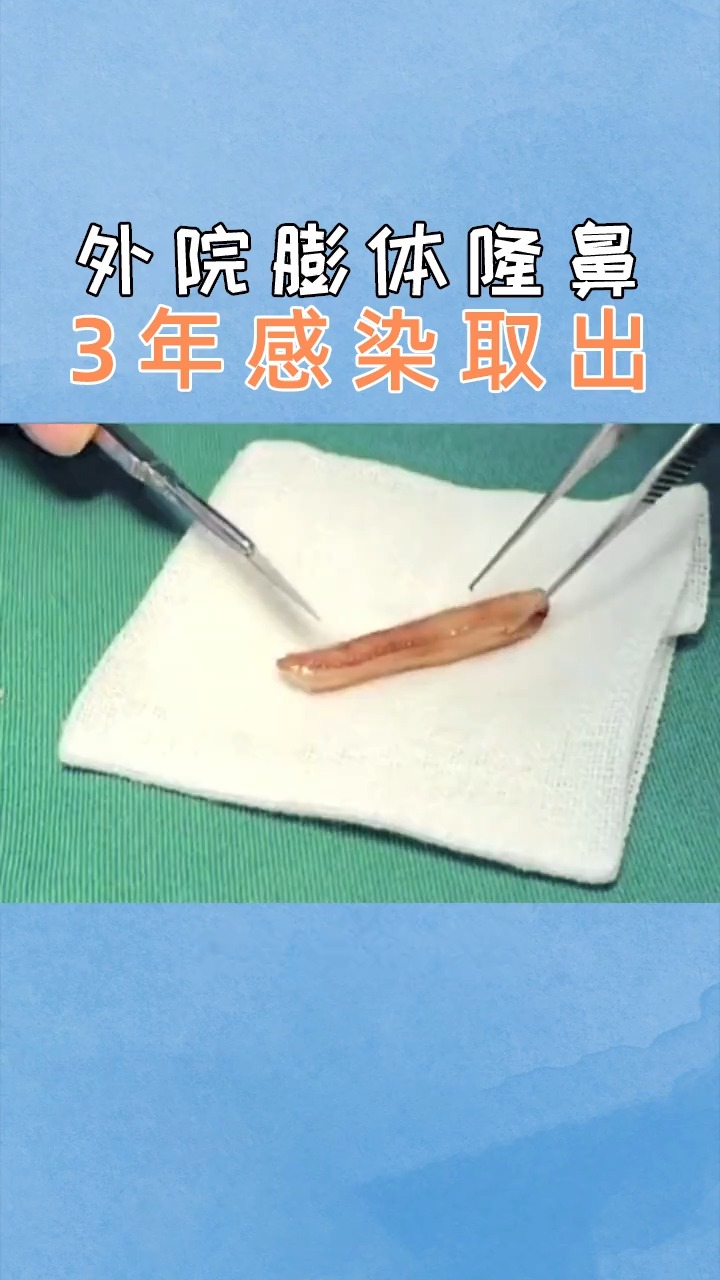 隆鼻外院膨体隆鼻3年感染取出肋软骨