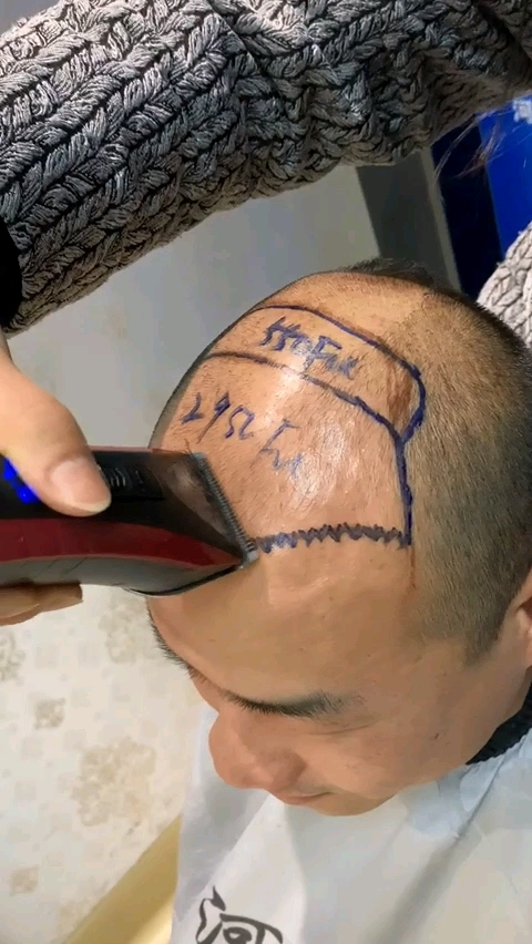 王先生u型脱发,术前准备中