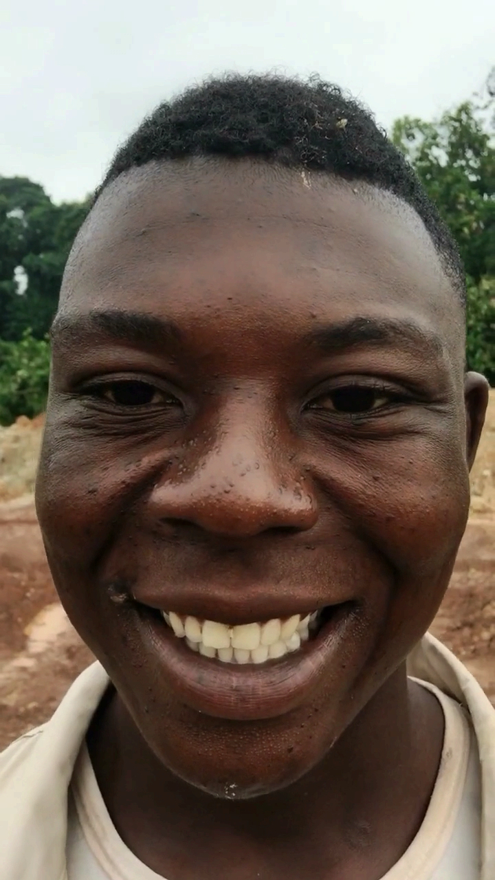 非洲黑人会不会长青春痘?