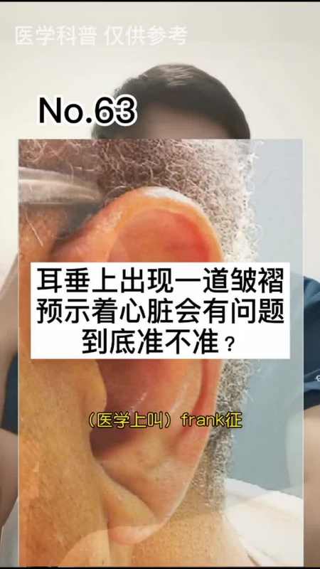 耳垂上有一道皱褶,预示着你的心脏有问题
