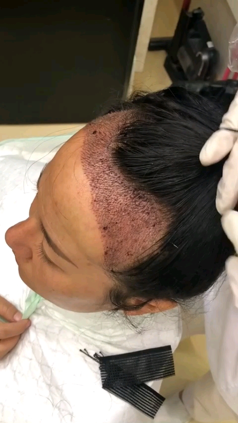 种发第二天,看着害怕,其实不疼的.从此告别单身和自卑!