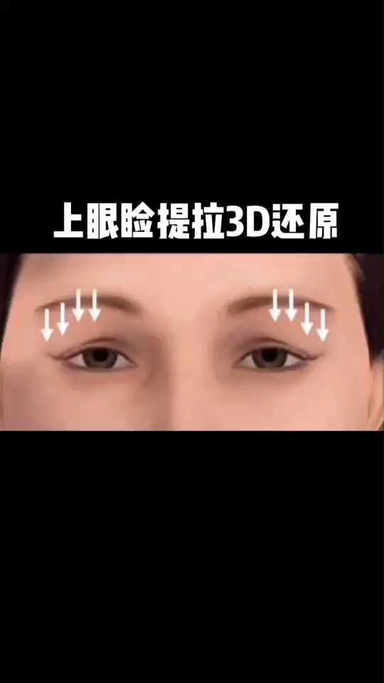 双眼皮#上眼睑提拉视频还原.-度小视