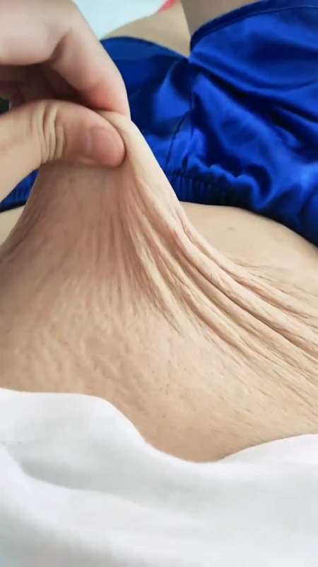 妊娠纹#宝妈29岁再也不受生娃之痛的经历了,只是再也不能穿露肚脐的