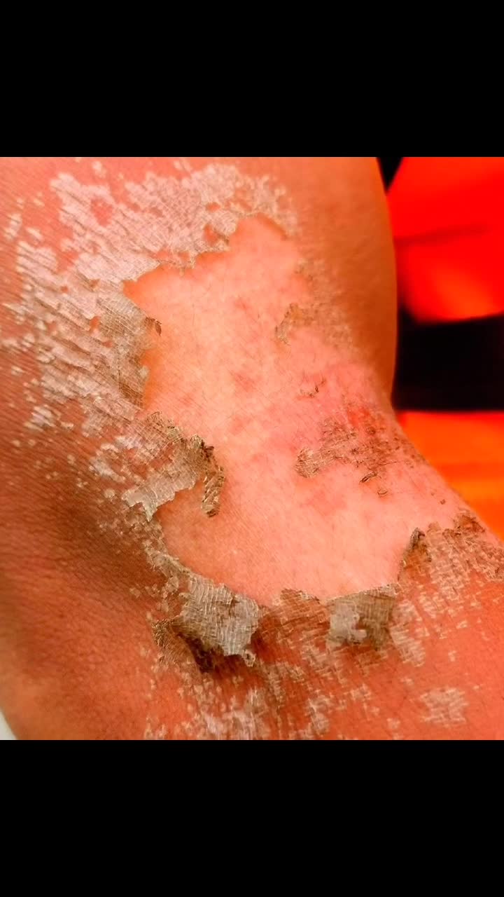 皮肤晒伤脱皮,他们却说这是"勋章"!