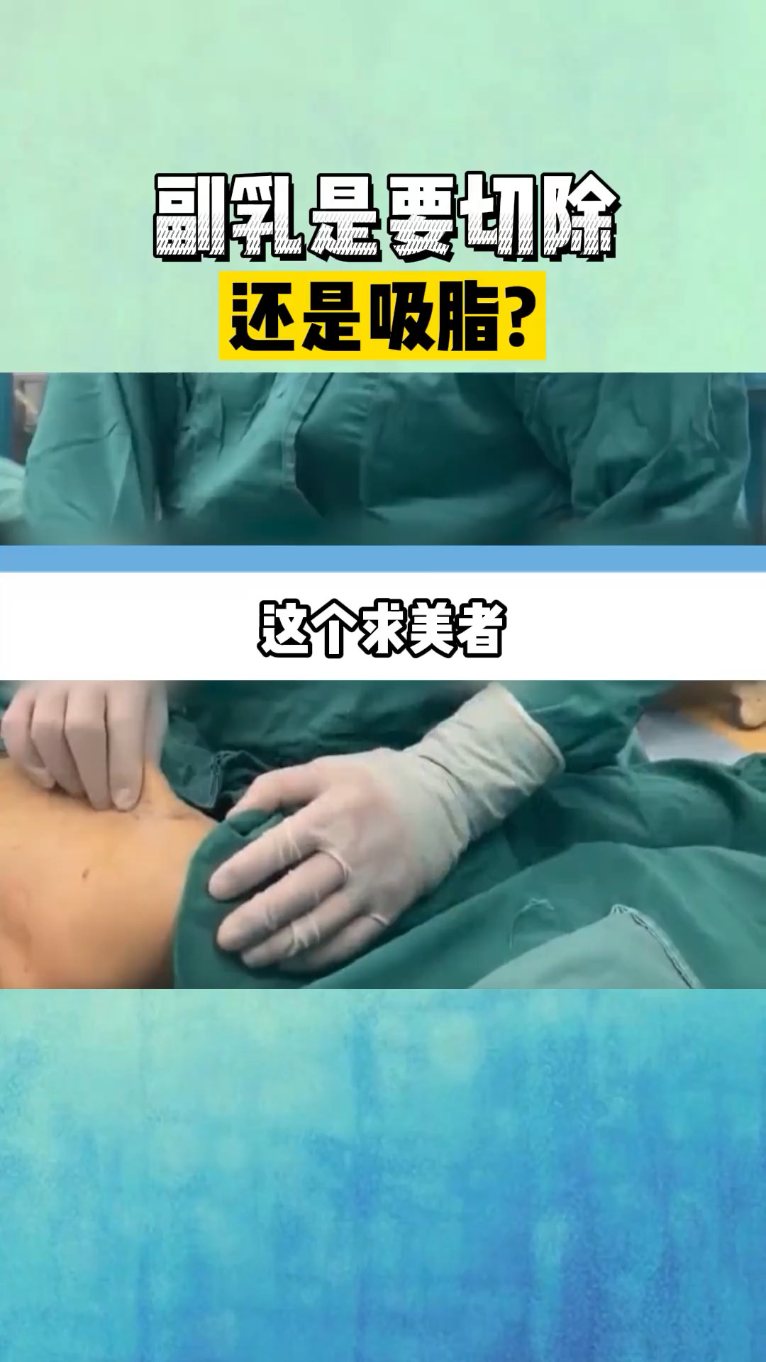 独竖一知副乳是切除还是吸脂