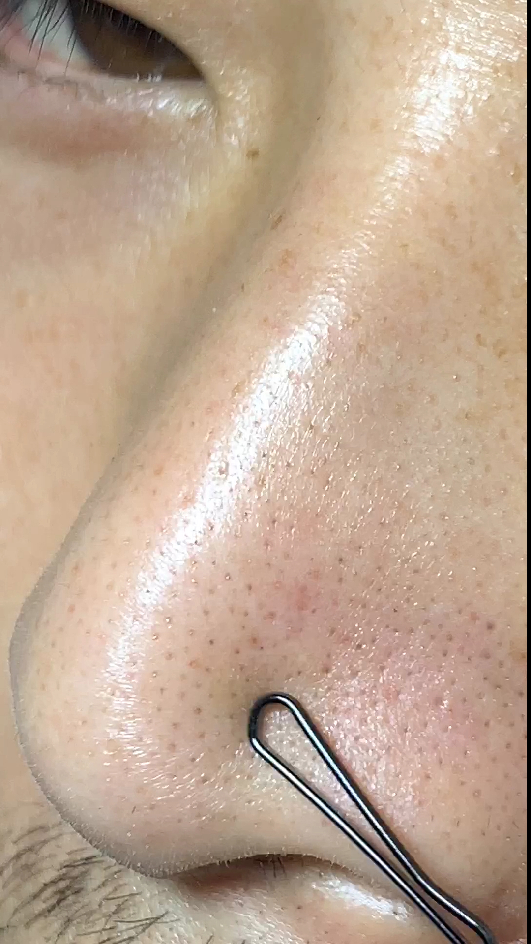 黑头白头粉刺一招解决