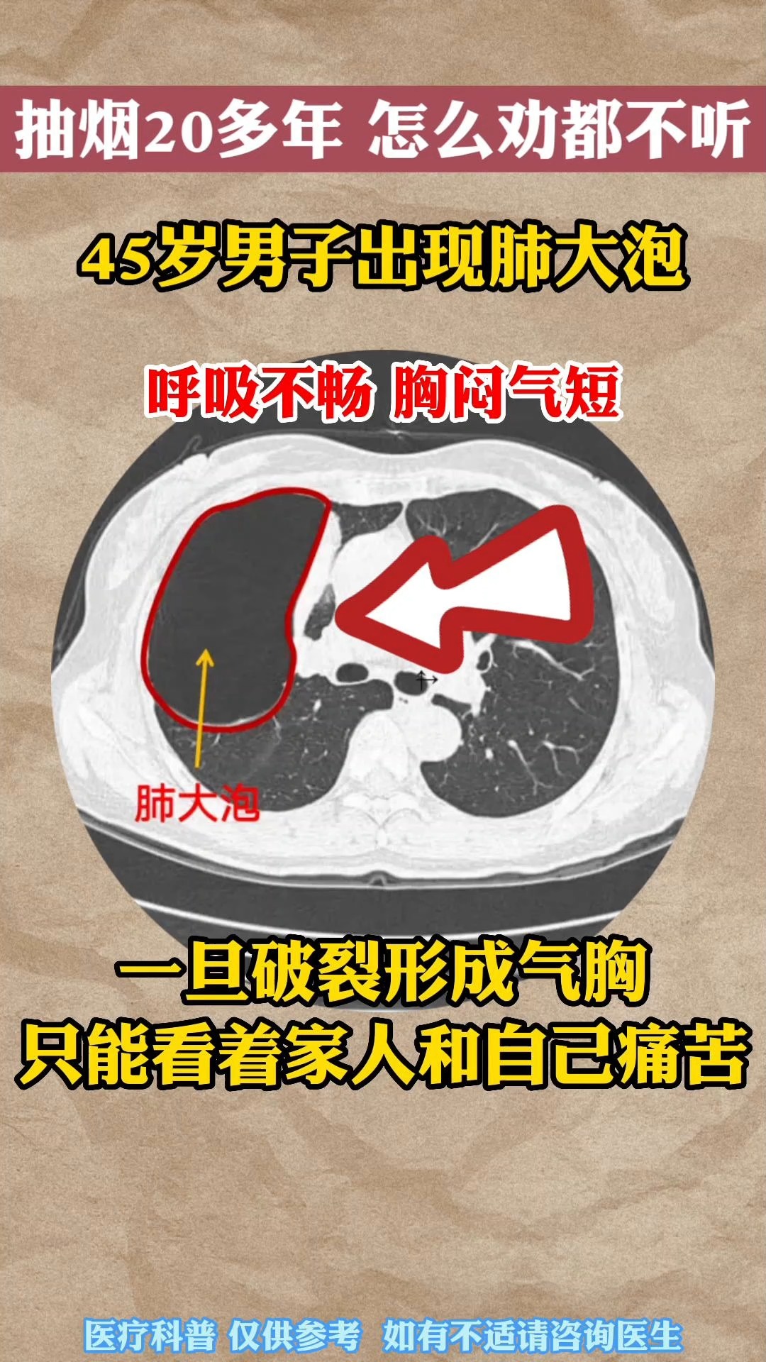 戒烟45岁老烟枪出现肺大炮呼吸不畅胸闷气短