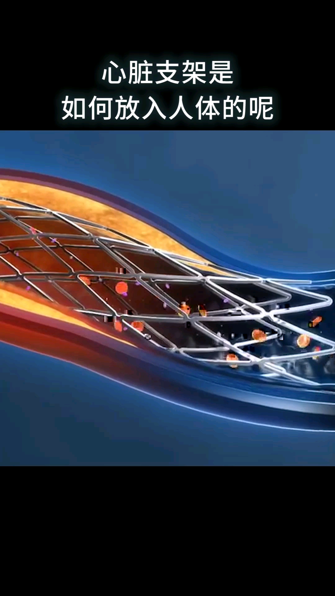 心脏支架是如何放进人体的?