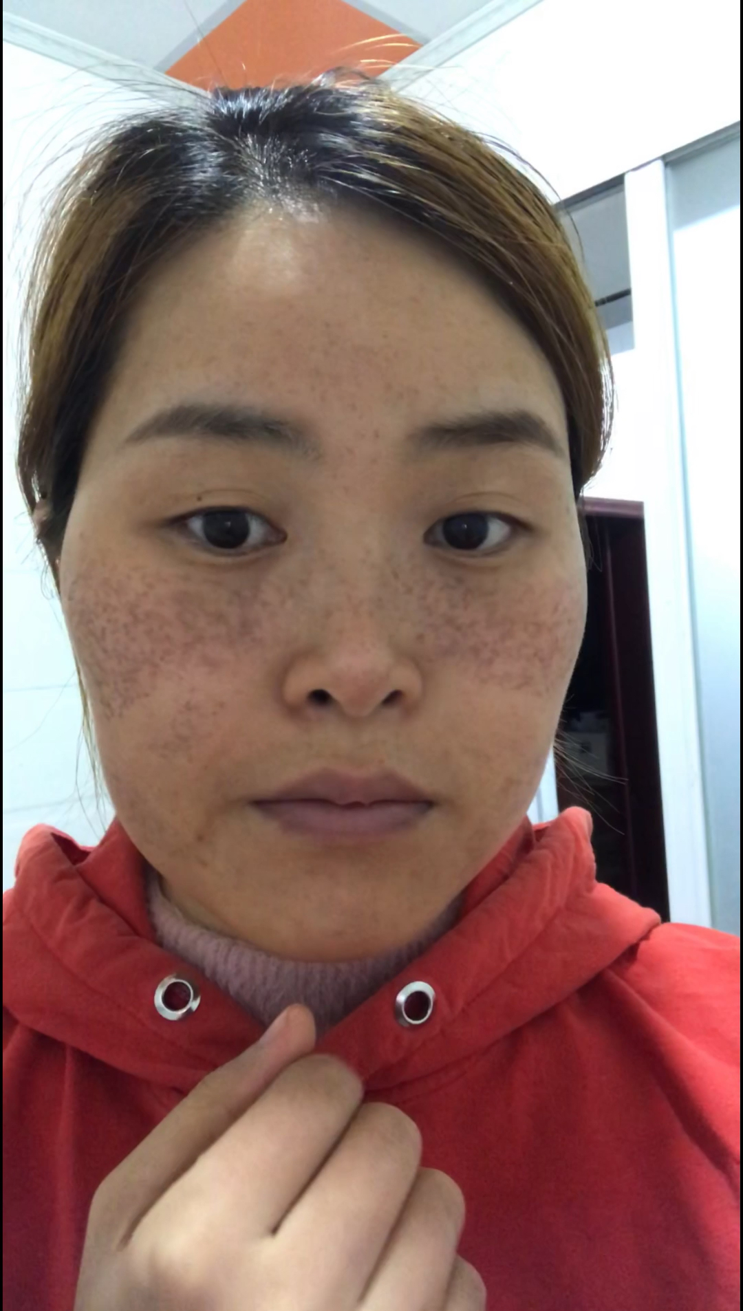 六年的麻子脸.两个多月的改变!