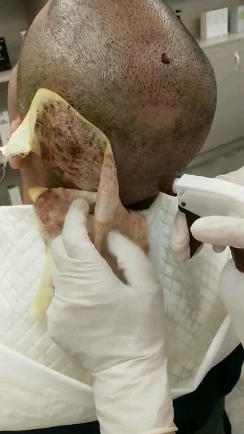 种发第二天,看着害怕,其实一点都不疼的.从此告别单身和自卑!