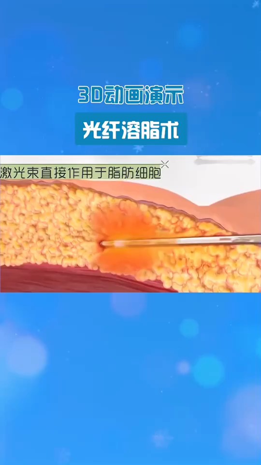 演示光纤溶脂术看完你还敢尝试吗