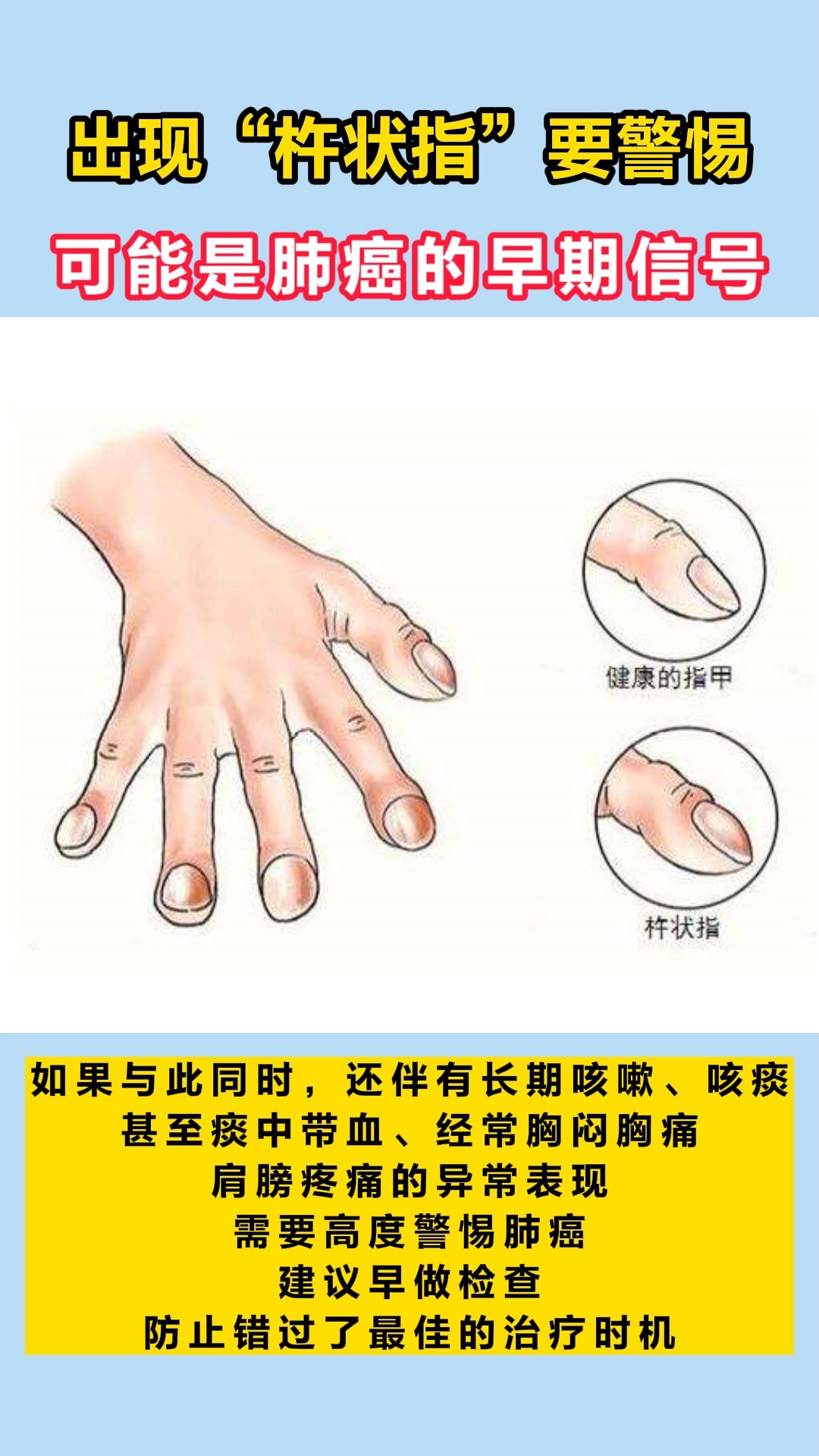 肿瘤#"杵状指"可能是肺癌早期信号