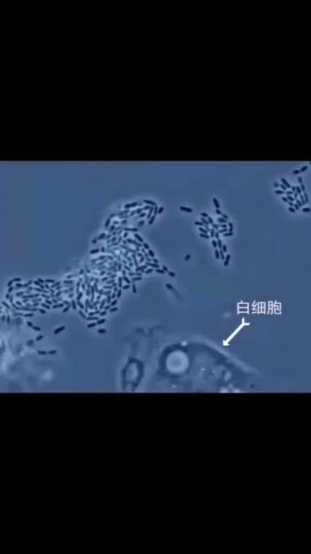 显微镜下白细胞正在吞噬病毒,抗击肺炎,我们一起打赢这一仗