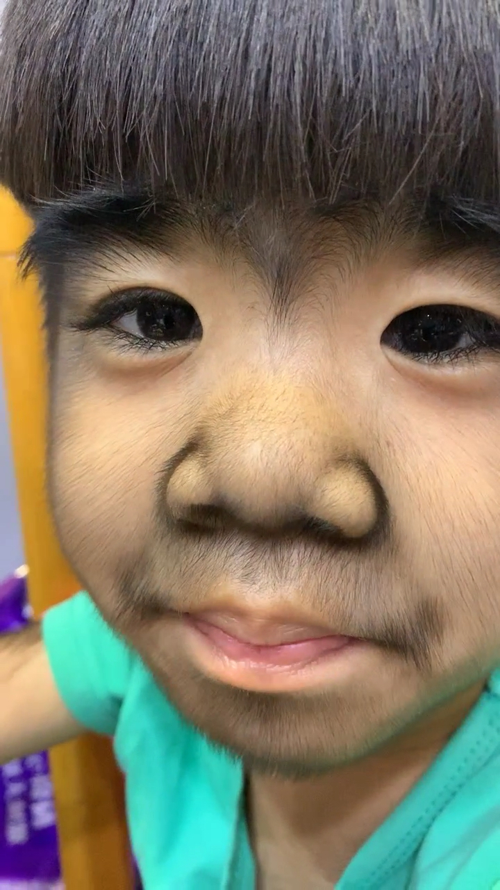 先天性多毛症患者,需要大家的包容和理解