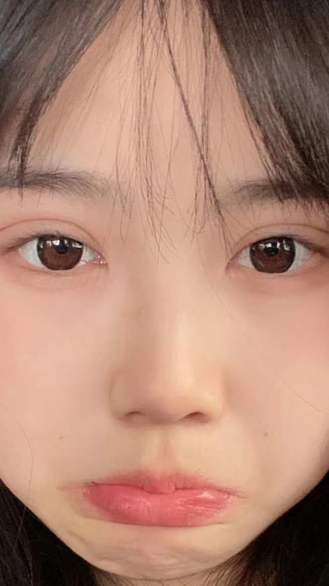 双眼皮#北京哪里可以修复肉条感双眼皮